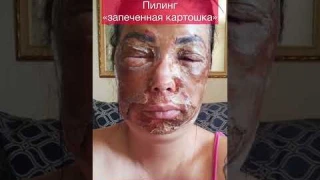 Супер омоложение -Феноловый пилинг дает потрясающие результаты ! #пилинг #омоложение #косметология