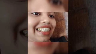My Braces journey/BRACES TRANSFORMATION VIDEO #shorts #shortvideo #braces #journey #trending #viral