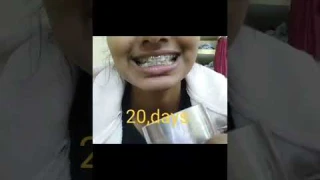 braces journey#shortvideo #toothbraces #nursing