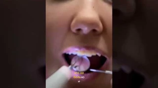Чищу сама дома зубы от камня и отбеляю 😳#зубы