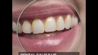 Dental Calculus Plaque Remover Tool Kit