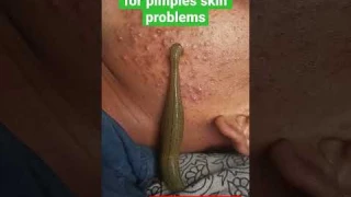 leech therapy for skin problems #pimples #ayurveda #skinproblems #shorts #panchkarma #hairfall #mp